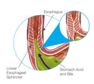 https://baysurgicalspecialists.com/wp-content/uploads/2019/10/GERD-Diagram-e1571667724741-300x270.png