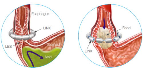 Linx - Bay Surgical Specialists | Vascular, Laparoscopic and Bariatric ...